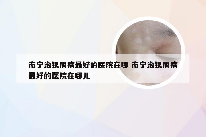 南宁治银屑病最好的医院在哪 南宁治银屑病最好的医院在哪儿