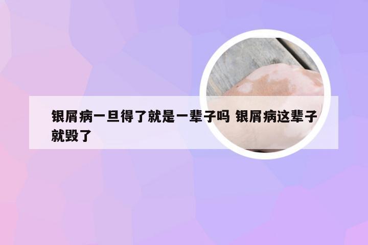 银屑病一旦得了就是一辈子吗 银屑病这辈子就毁了