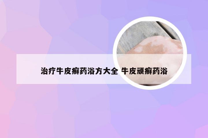 治疗牛皮癣药浴方大全 牛皮顽癣药浴