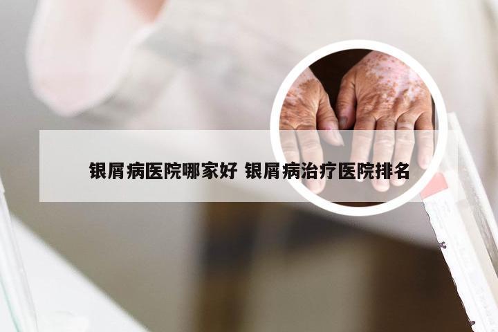 银屑病医院哪家好 银屑病治疗医院排名