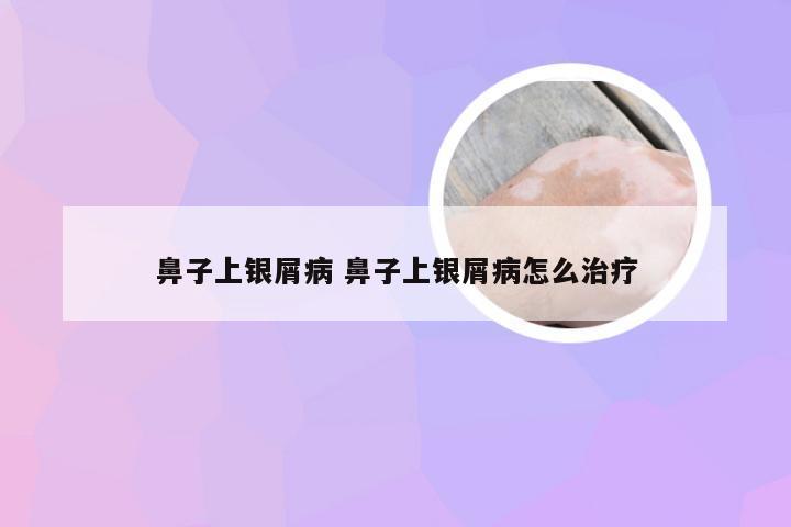 鼻子上银屑病 鼻子上银屑病怎么治疗