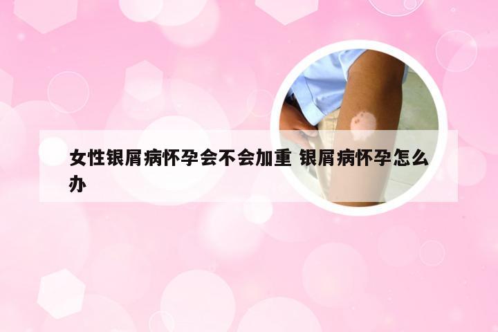 女性银屑病怀孕会不会加重 银屑病怀孕怎么办