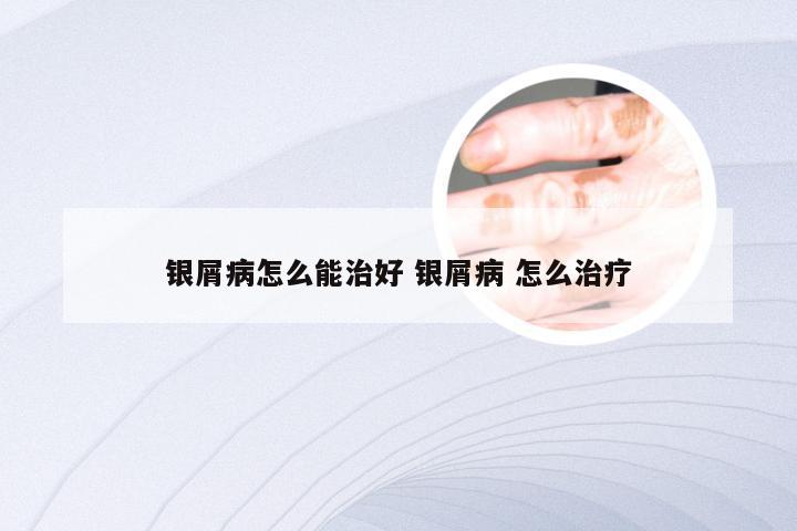 银屑病怎么能治好 银屑病 怎么治疗