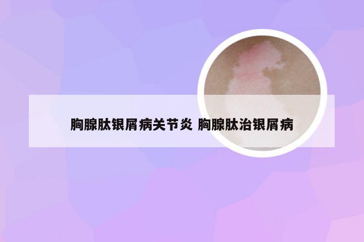 胸腺肽银屑病关节炎 胸腺肽治银屑病