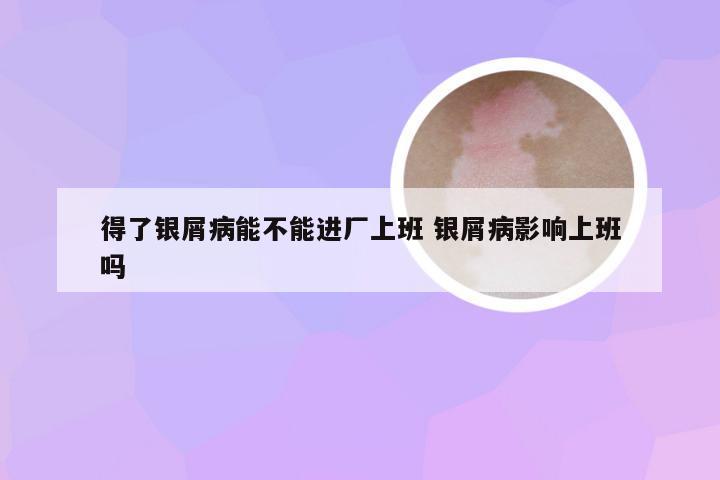 得了银屑病能不能进厂上班 银屑病影响上班吗