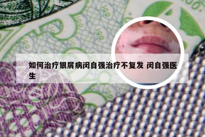 如何治疗银屑病闵自强治疗不复发 闵自强医生