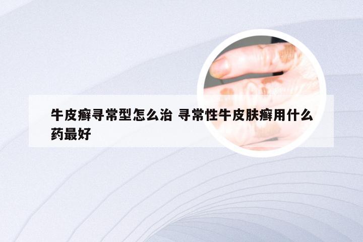 牛皮癣寻常型怎么治 寻常性牛皮肤癣用什么药最好