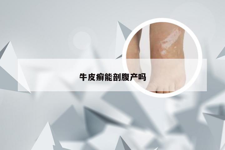 牛皮癣能剖腹产吗