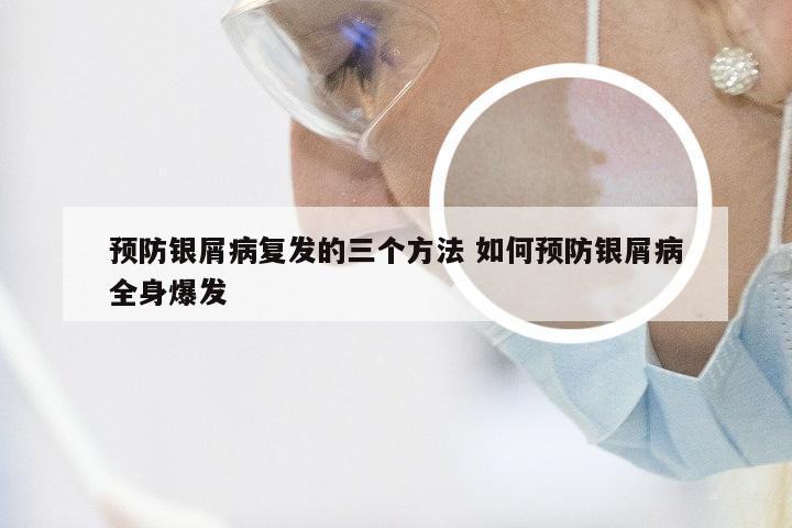 预防银屑病复发的三个方法 如何预防银屑病全身爆发