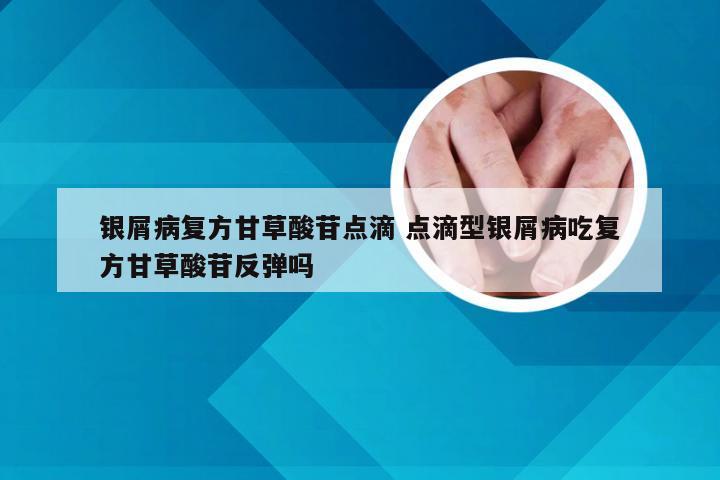 银屑病复方甘草酸苷点滴 点滴型银屑病吃复方甘草酸苷反弹吗