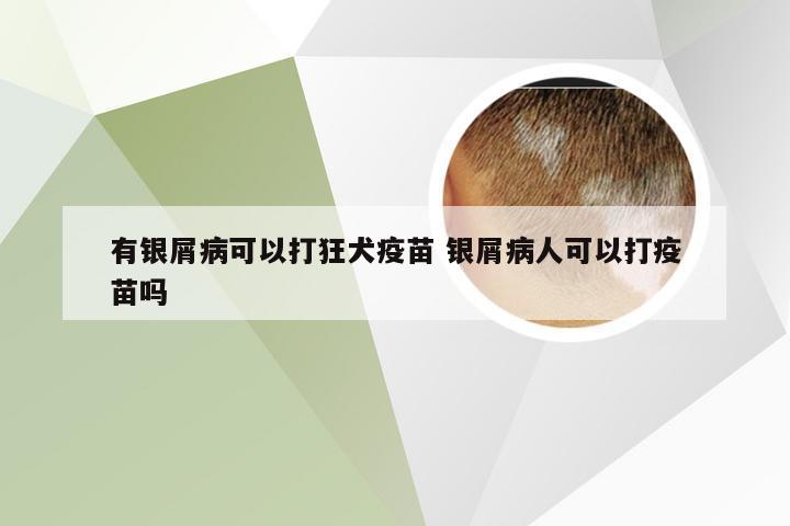 有银屑病可以打狂犬疫苗 银屑病人可以打疫苗吗