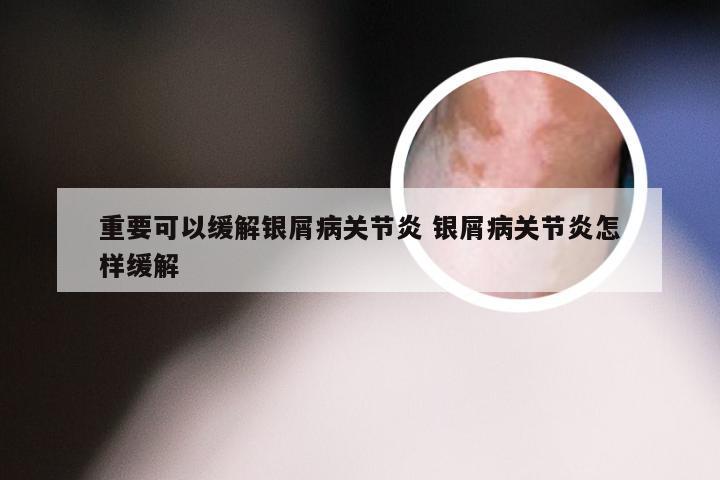 重要可以缓解银屑病关节炎 银屑病关节炎怎样缓解