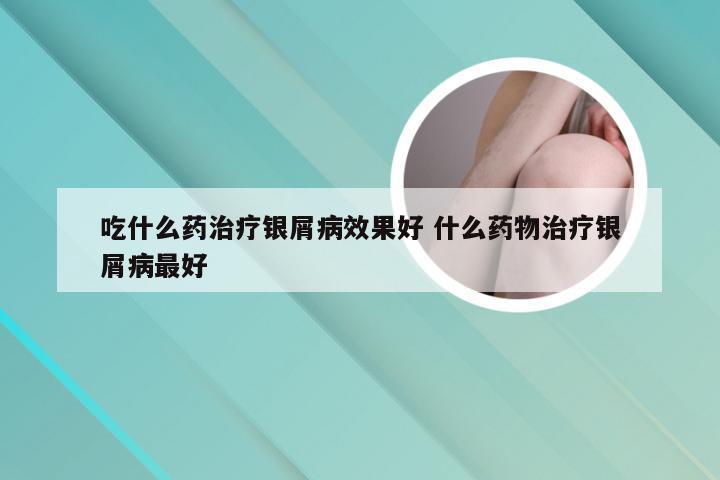 吃什么药治疗银屑病效果好 什么药物治疗银屑病最好