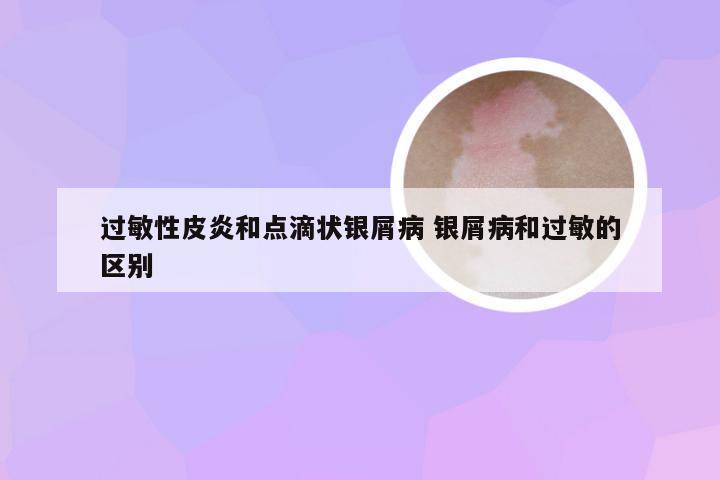 过敏性皮炎和点滴状银屑病 银屑病和过敏的区别