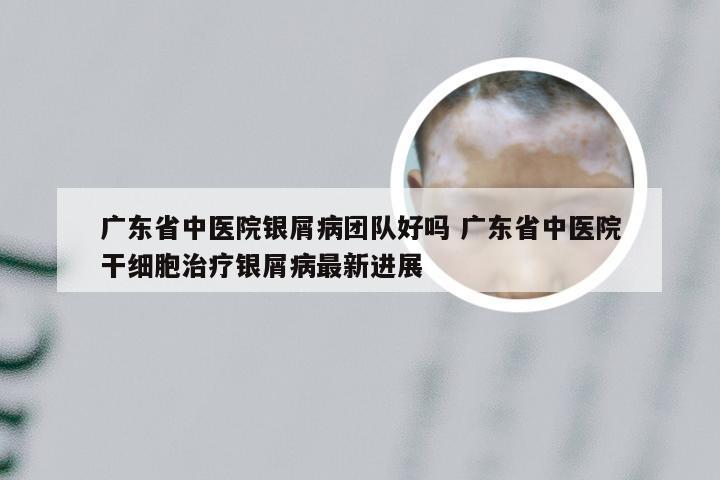 广东省中医院银屑病团队好吗 广东省中医院干细胞治疗银屑病最新进展