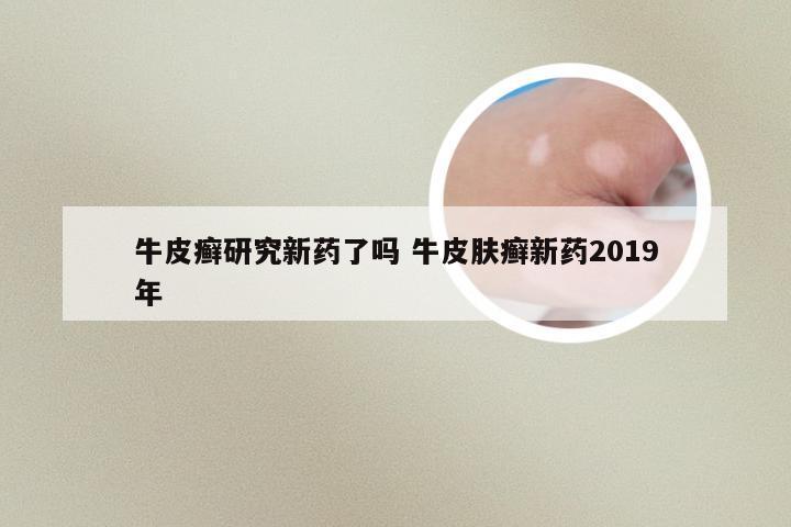 牛皮癣研究新药了吗 牛皮肤癣新药2019年