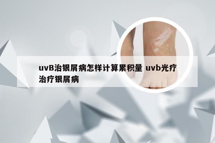 uvB治银屑病怎样计算累积量 uvb光疗治疗银屑病