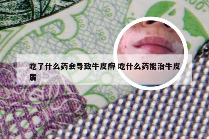 吃了什么药会导致牛皮癣 吃什么药能治牛皮屑