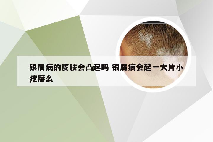 银屑病的皮肤会凸起吗 银屑病会起一大片小疙瘩么