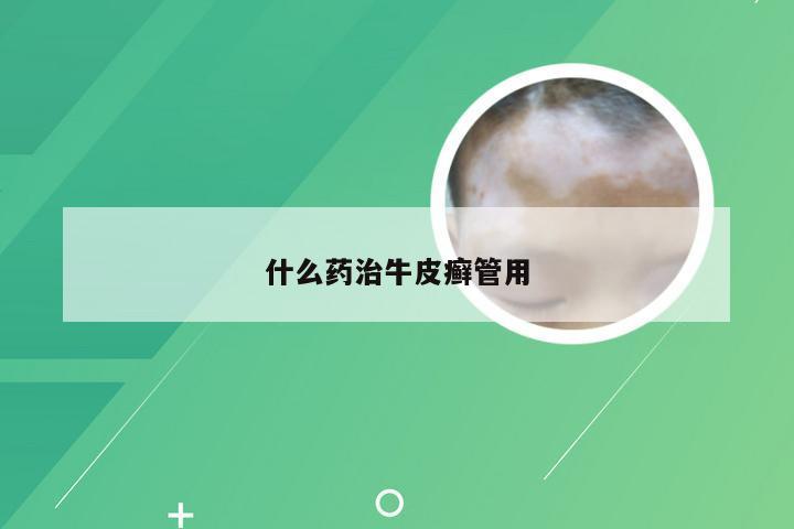 什么药治牛皮癣管用