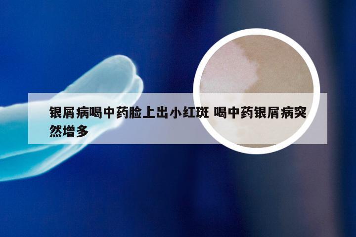 银屑病喝中药脸上出小红斑 喝中药银屑病突然增多