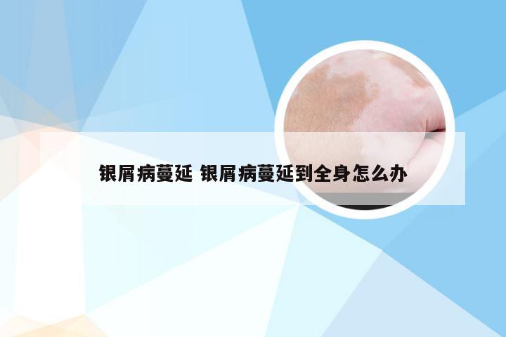 银屑病蔓延 银屑病蔓延到全身怎么办