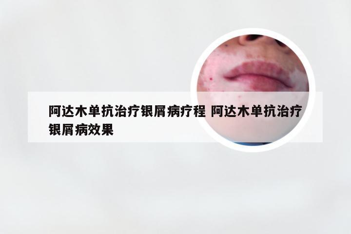 阿达木单抗治疗银屑病疗程 阿达木单抗治疗银屑病效果