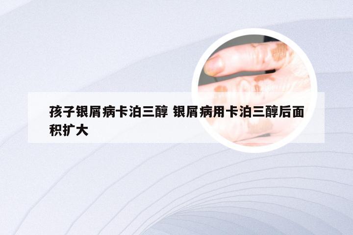 孩子银屑病卡泊三醇 银屑病用卡泊三醇后面积扩大