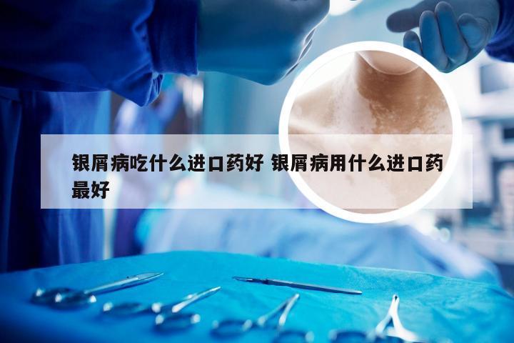 银屑病吃什么进口药好 银屑病用什么进口药最好