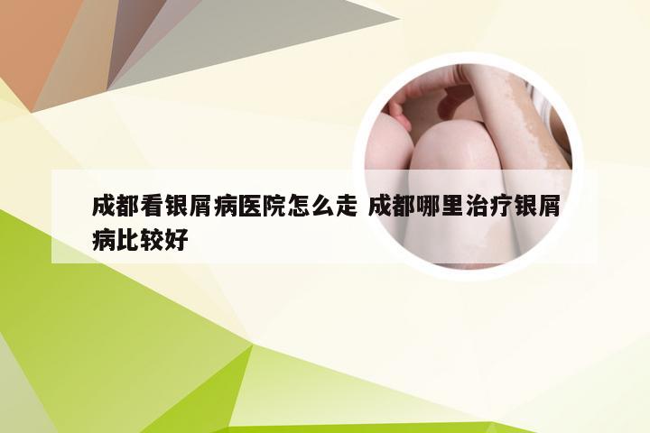 成都看银屑病医院怎么走 成都哪里治疗银屑病比较好