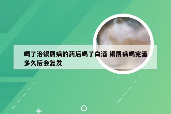 喝了治银屑病的药后喝了白酒 银屑病喝完酒多久后会复发