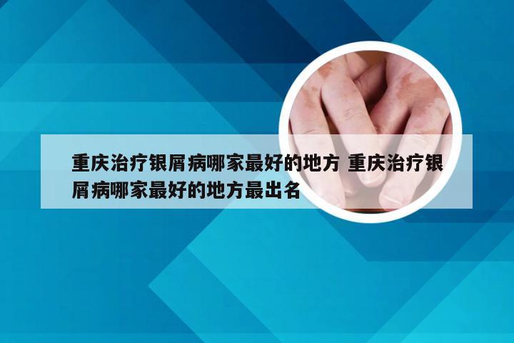 重庆治疗银屑病哪家最好的地方 重庆治疗银屑病哪家最好的地方最出名