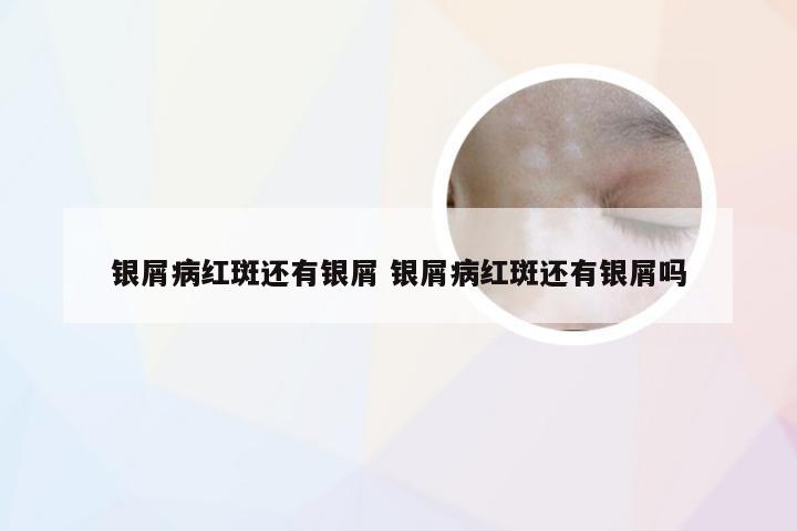 银屑病红斑还有银屑 银屑病红斑还有银屑吗