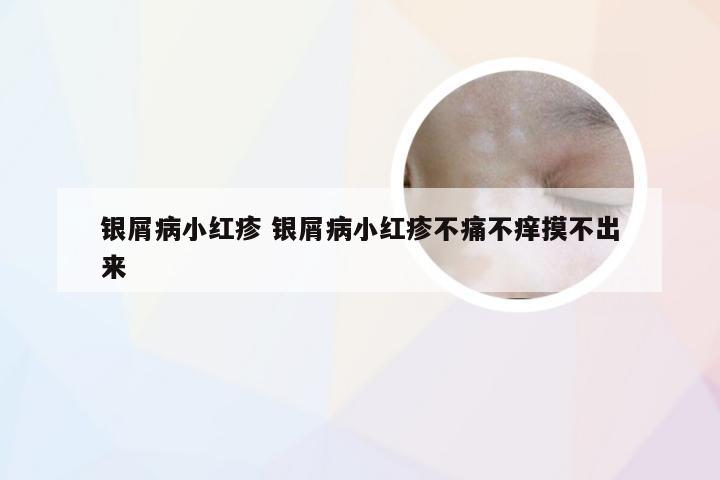 银屑病小红疹 银屑病小红疹不痛不痒摸不出来