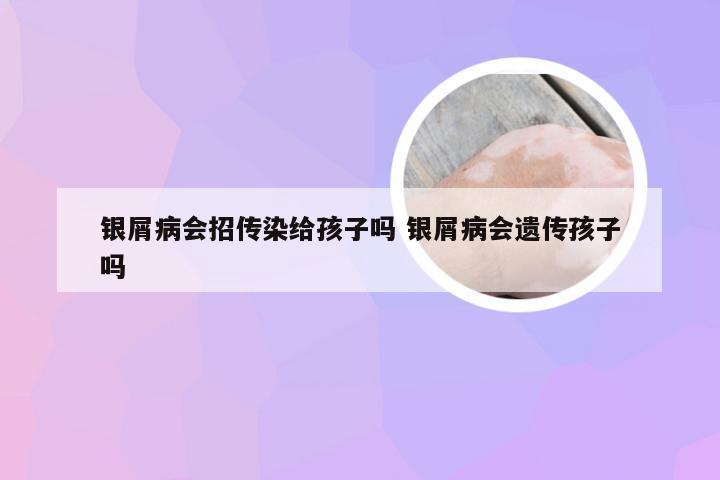 银屑病会招传染给孩子吗 银屑病会遗传孩子吗