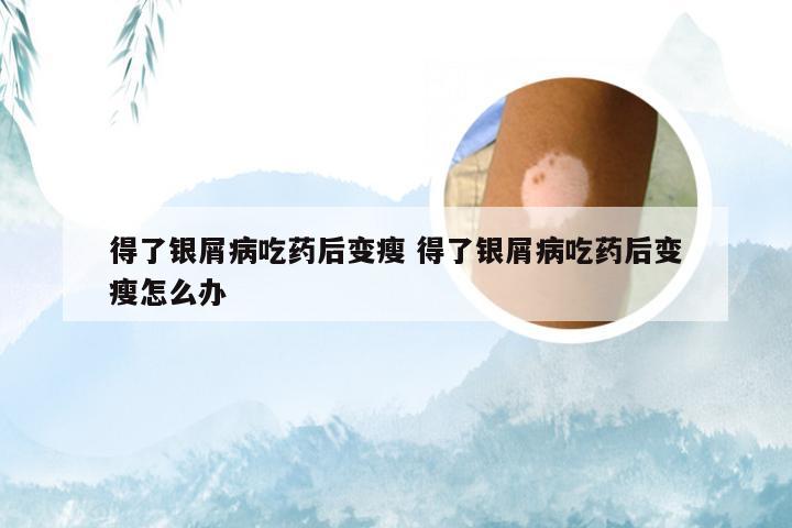 得了银屑病吃药后变瘦 得了银屑病吃药后变瘦怎么办