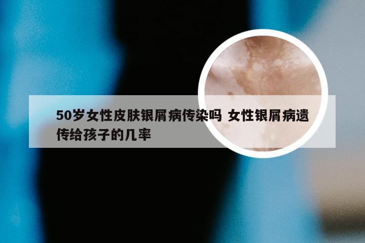 50岁女性皮肤银屑病传染吗 女性银屑病遗传给孩子的几率