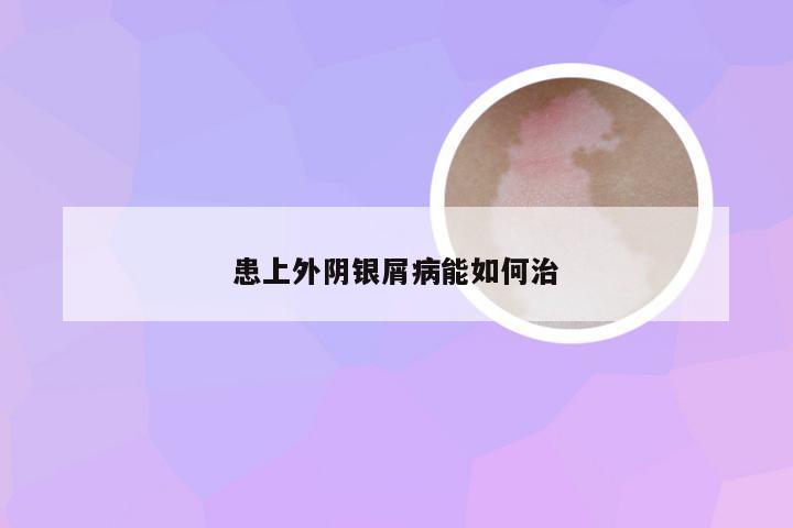 患上外阴银屑病能如何治