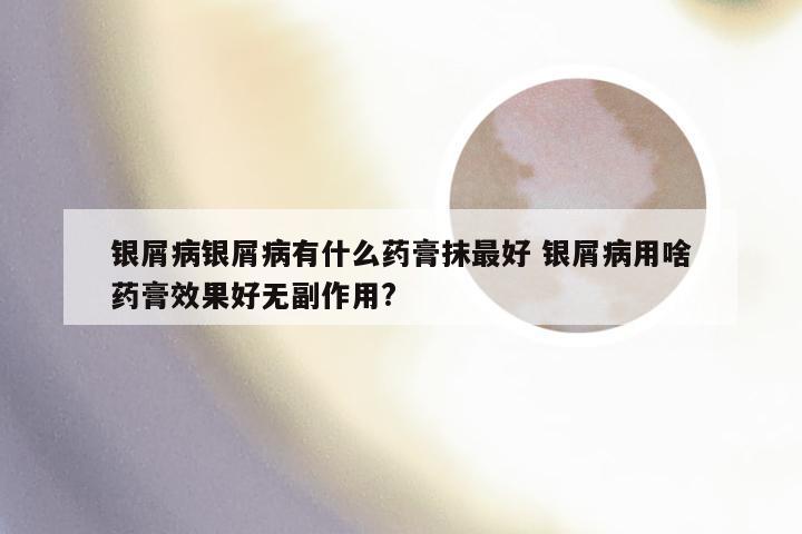 银屑病银屑病有什么药膏抹最好 银屑病用啥药膏效果好无副作用?