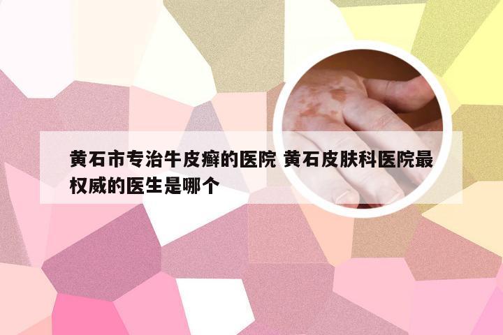 黄石市专治牛皮癣的医院 黄石皮肤科医院最权威的医生是哪个