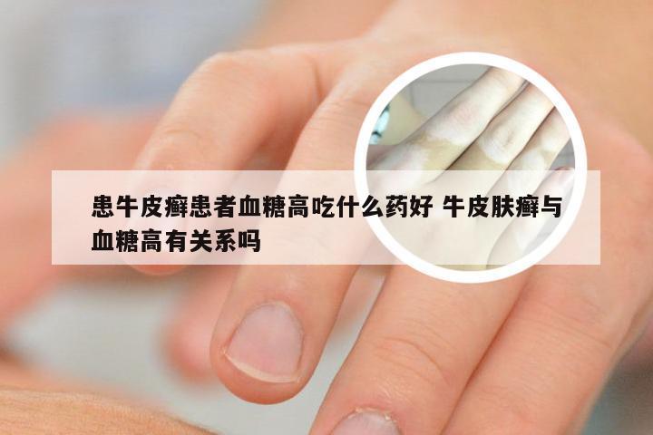 患牛皮癣患者血糖高吃什么药好 牛皮肤癣与血糖高有关系吗