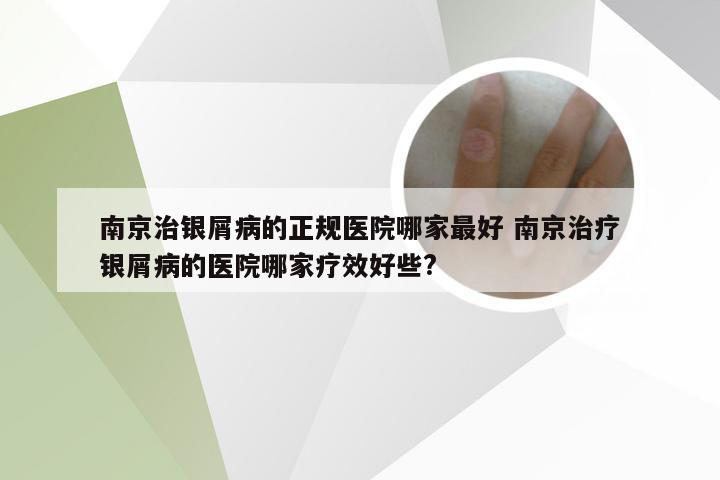 南京治银屑病的正规医院哪家最好 南京治疗银屑病的医院哪家疗效好些?