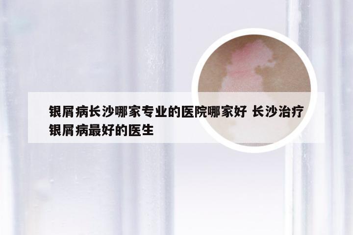 银屑病长沙哪家专业的医院哪家好 长沙治疗银屑病最好的医生