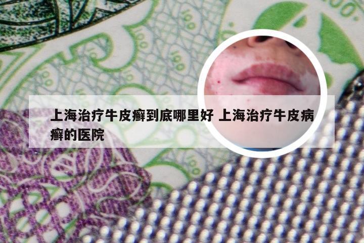 上海治疗牛皮癣到底哪里好 上海治疗牛皮病癣的医院