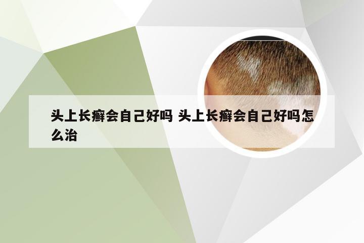 头上长癣会自己好吗 头上长癣会自己好吗怎么治