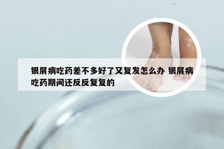 银屑病吃药差不多好了又复发怎么办 银屑病吃药期间还反反复复的