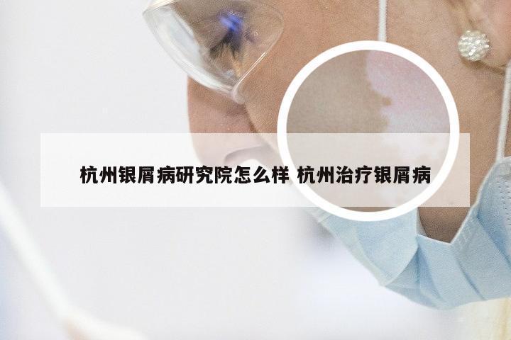 杭州银屑病研究院怎么样 杭州治疗银屑病