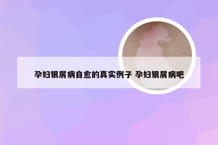 孕妇银屑病自愈的真实例子 孕妇银屑病吧