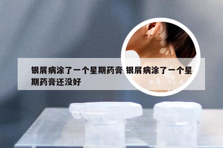 银屑病涂了一个星期药膏 银屑病涂了一个星期药膏还没好