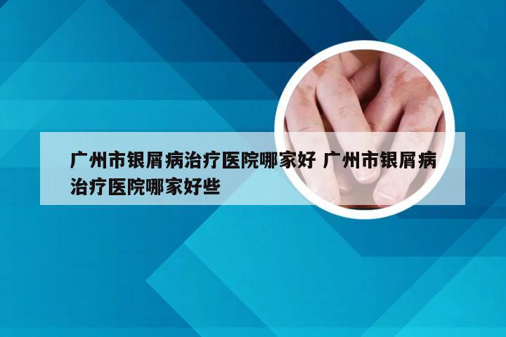 广州市银屑病治疗医院哪家好 广州市银屑病治疗医院哪家好些